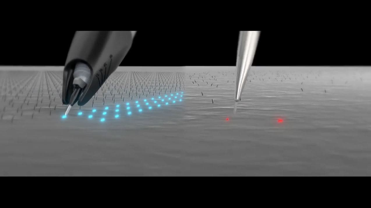 Robotik saç ekimi cihazı Roboen